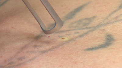 Félix leva quince anos retirando tatuaxes
