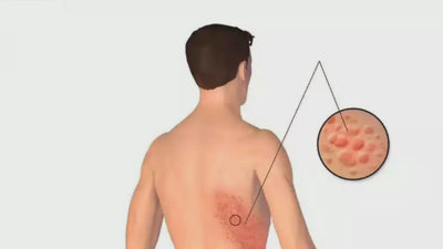 Un zóster mal curado pode derivar nunha doenza chamada neuralxia posherpética