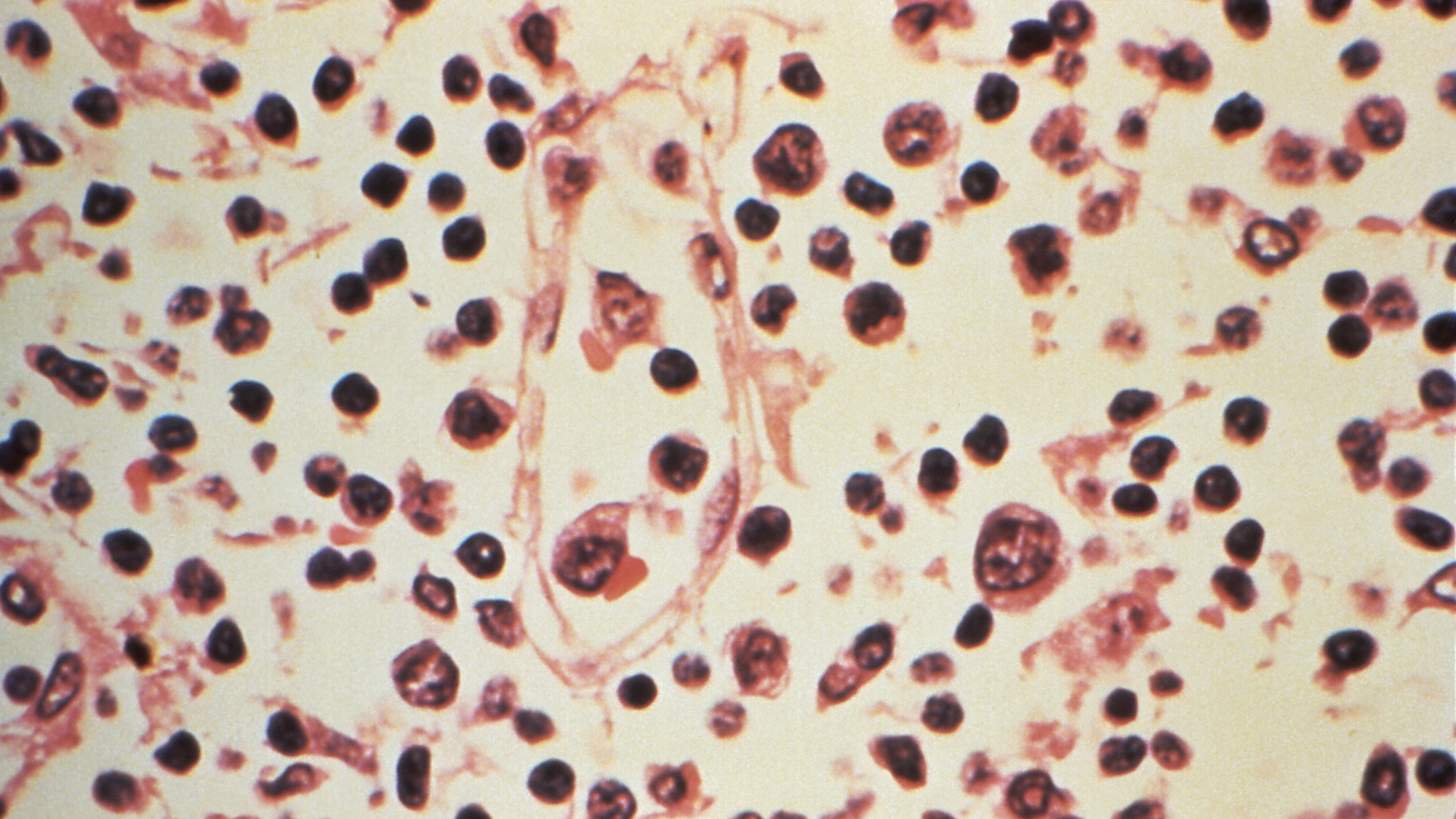 Ganglio linfático extraído dun paciente sospeitoso de ter Hantavirus. Reuters