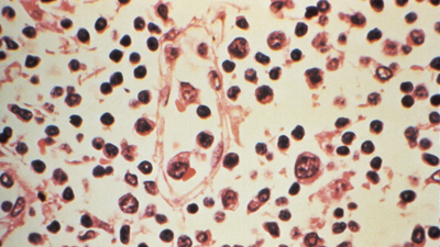 Ganglio linfático extraído dun paciente sospeitoso de ter Hantavirus. Reuters