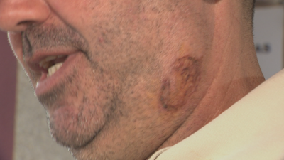 Marcas das dentadas no pescozo dunha das vítimas
